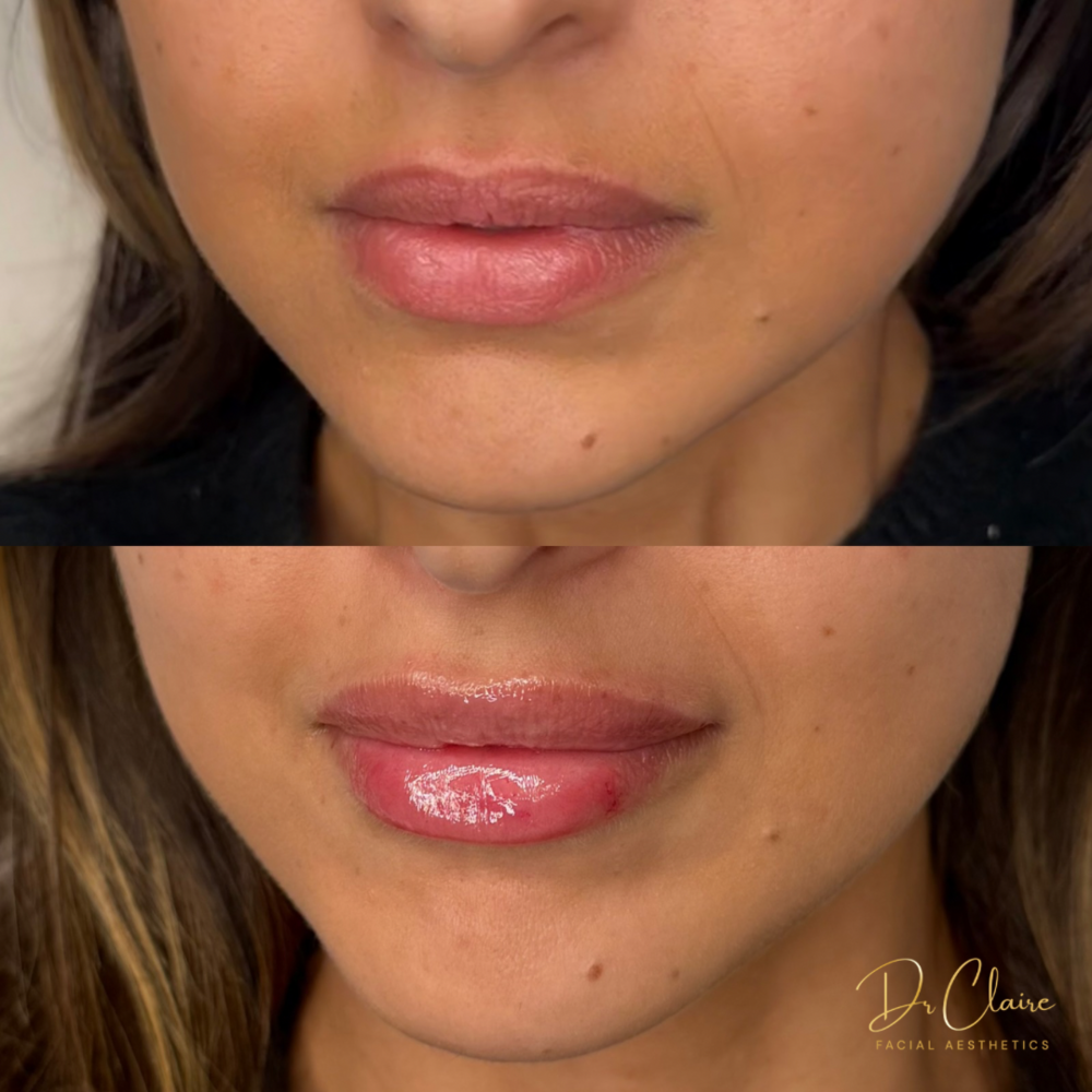 Transformations | Dr Claire Facial Aesthetics | Botox Chorley | Fillers Chorley | Aesthetics Chorley | Botox Treatments Chorley | Dermal Fillers Chorley | Aesthetic Enhancements Chorley