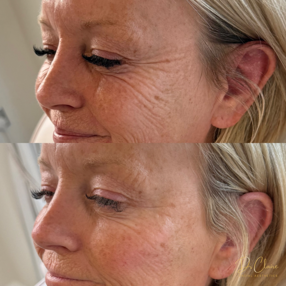 Transformations | Dr Claire Facial Aesthetics | Botox Chorley | Fillers Chorley | Aesthetics Chorley | Botox Treatments Chorley | Dermal Fillers Chorley | Aesthetic Enhancements Chorley