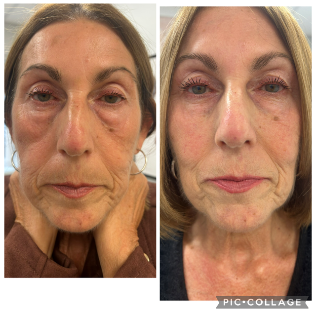 Before &amp; After | Clk medical aesthetics