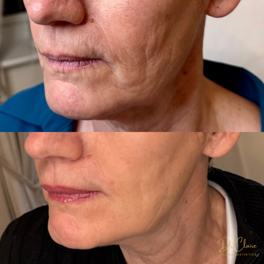Transformations | Dr Claire Facial Aesthetics | Botox Chorley | Fillers Chorley | Aesthetics Chorley | Botox Treatments Chorley | Dermal Fillers Chorley | Aesthetic Enhancements Chorley