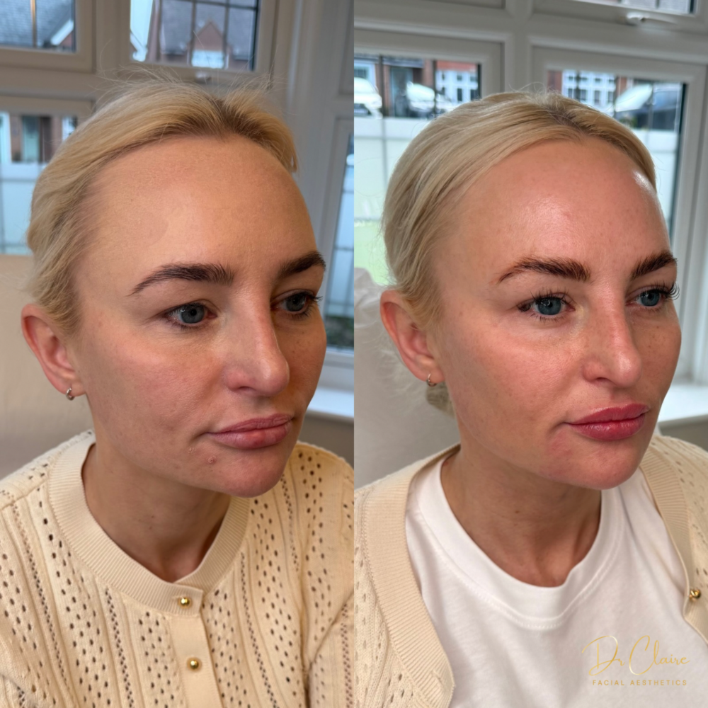 Transformations | Dr Claire Facial Aesthetics | Botox Chorley | Fillers Chorley | Aesthetics Chorley | Botox Treatments Chorley | Dermal Fillers Chorley | Aesthetic Enhancements Chorley