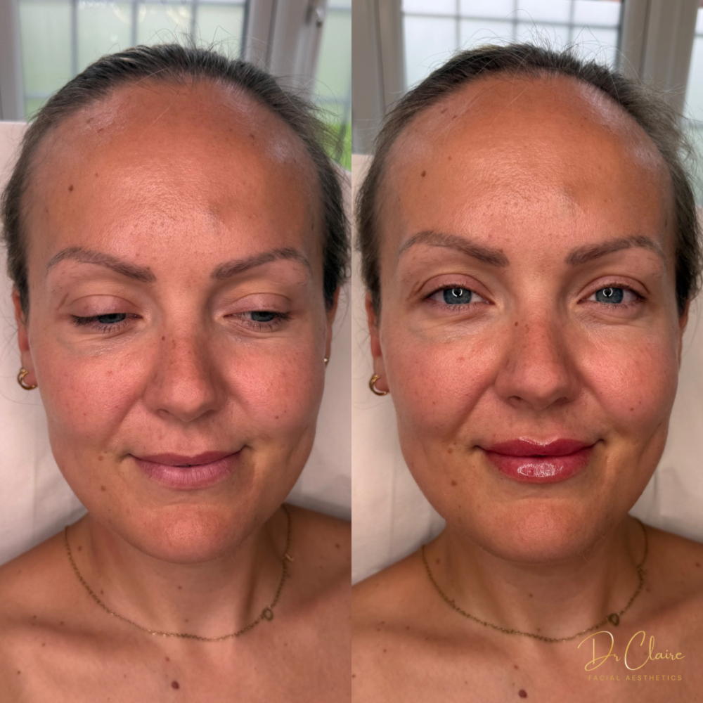 Transformations | Dr Claire Facial Aesthetics | Botox Chorley | Fillers Chorley | Aesthetics Chorley | Botox Treatments Chorley | Dermal Fillers Chorley | Aesthetic Enhancements Chorley