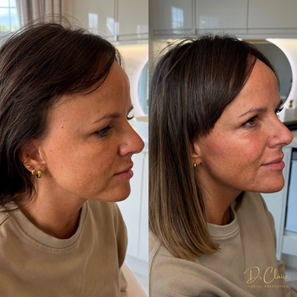 Transformations | Dr Claire Facial Aesthetics | Botox Chorley | Fillers Chorley | Aesthetics Chorley | Botox Treatments Chorley | Dermal Fillers Chorley | Aesthetic Enhancements Chorley