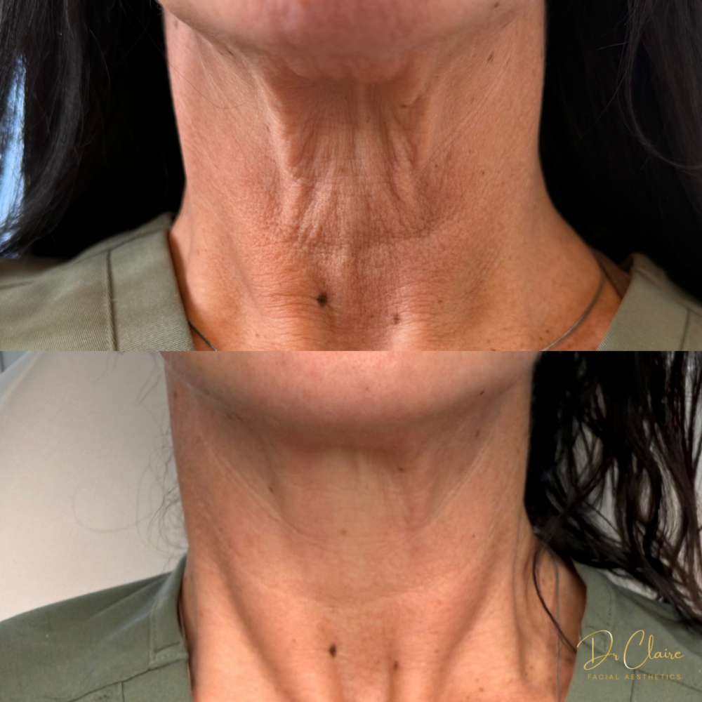 Transformations | Dr Claire Facial Aesthetics | Botox Chorley | Fillers Chorley | Aesthetics Chorley | Botox Treatments Chorley | Dermal Fillers Chorley | Aesthetic Enhancements Chorley
