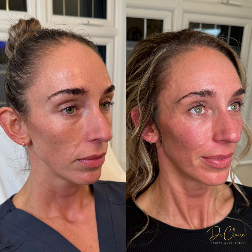 Transformations | Dr Claire Facial Aesthetics | Botox Chorley | Fillers Chorley | Aesthetics Chorley | Botox Treatments Chorley | Dermal Fillers Chorley | Aesthetic Enhancements Chorley