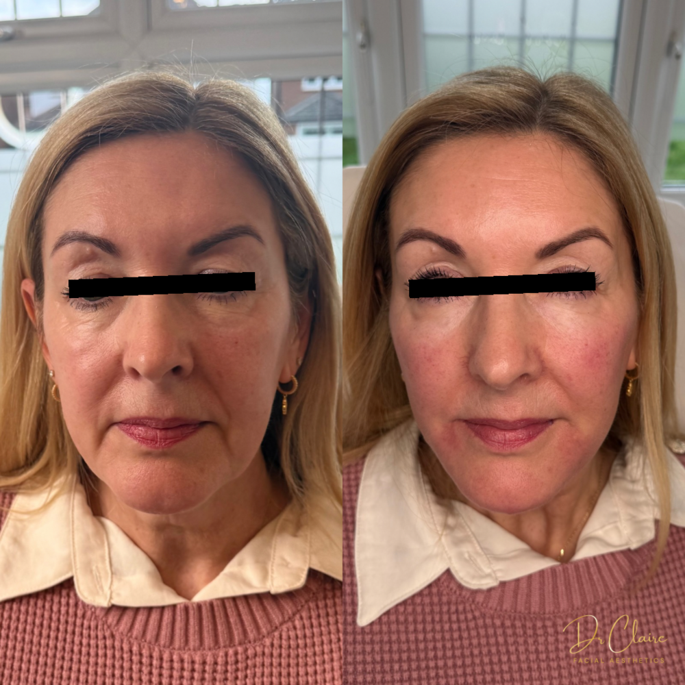 Transformations | Dr Claire Facial Aesthetics | Botox Chorley | Fillers Chorley | Aesthetics Chorley | Botox Treatments Chorley | Dermal Fillers Chorley | Aesthetic Enhancements Chorley