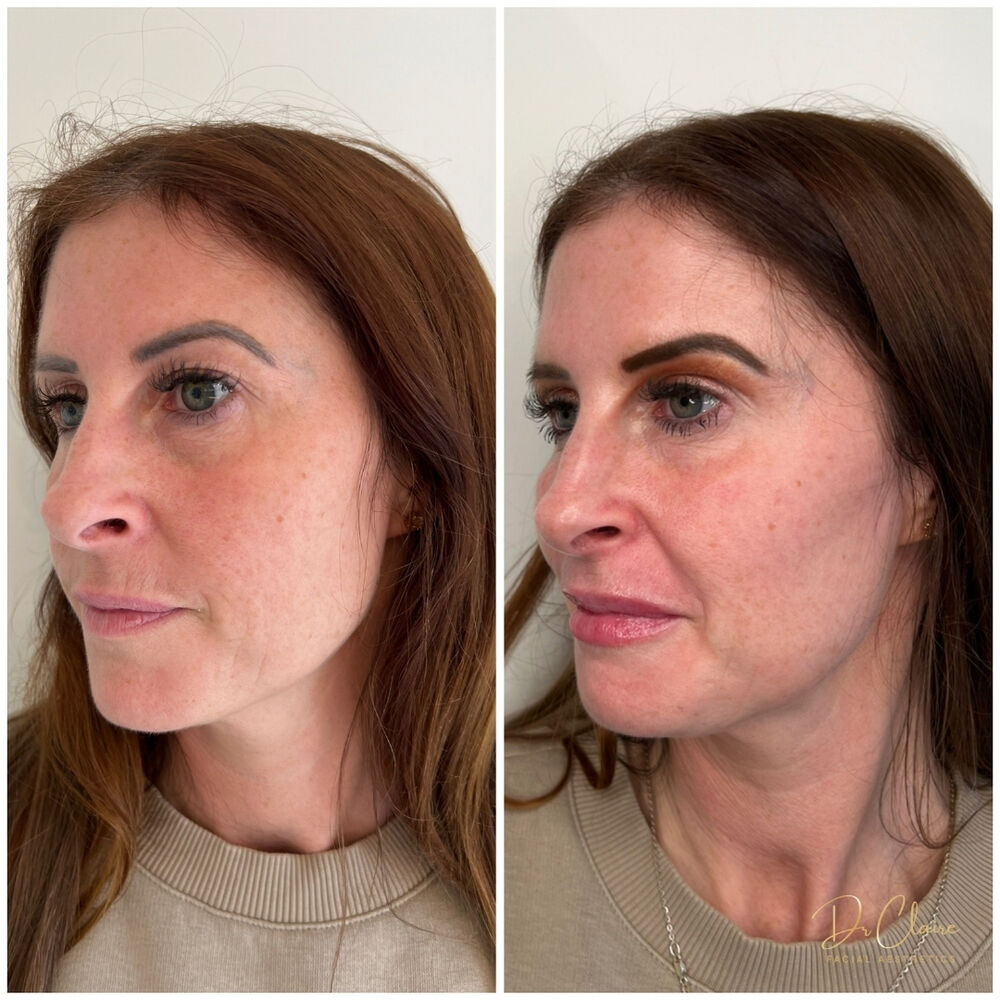 Transformations | Dr Claire Facial Aesthetics | Botox Chorley | Fillers Chorley | Aesthetics Chorley | Botox Treatments Chorley | Dermal Fillers Chorley | Aesthetic Enhancements Chorley
