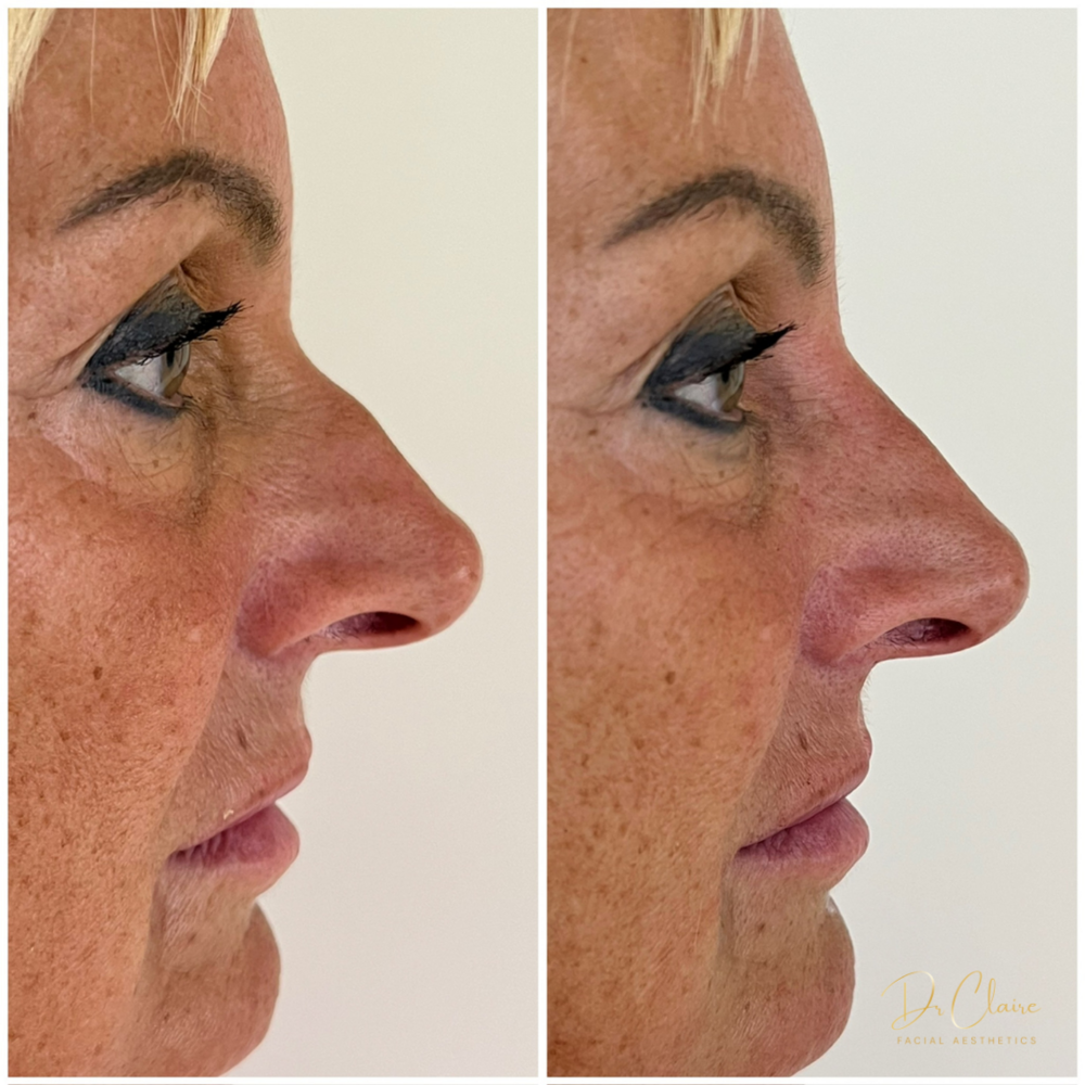 Transformations | Dr Claire Facial Aesthetics | Botox Chorley | Fillers Chorley | Aesthetics Chorley | Botox Treatments Chorley | Dermal Fillers Chorley | Aesthetic Enhancements Chorley