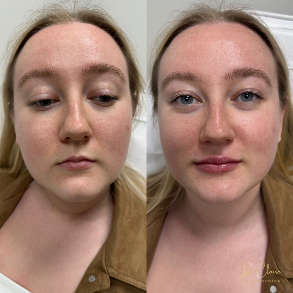 Transformations | Dr Claire Facial Aesthetics | Botox Chorley | Fillers Chorley | Aesthetics Chorley | Botox Treatments Chorley | Dermal Fillers Chorley | Aesthetic Enhancements Chorley