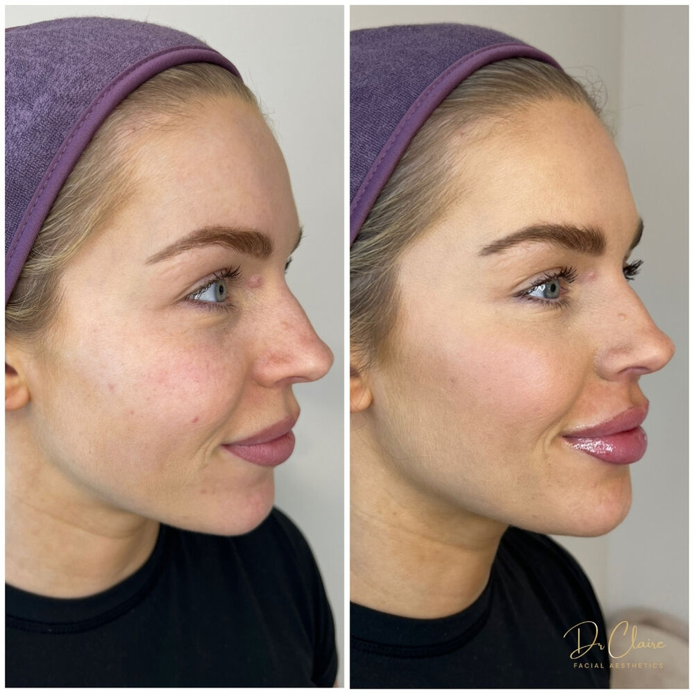Transformations | Dr Claire Facial Aesthetics | Botox Chorley | Fillers Chorley | Aesthetics Chorley | Botox Treatments Chorley | Dermal Fillers Chorley | Aesthetic Enhancements Chorley