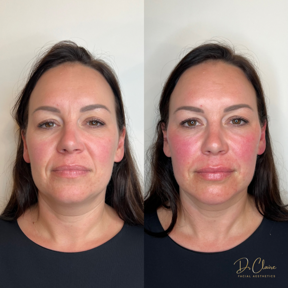 Transformations | Dr Claire Facial Aesthetics | Botox Chorley | Fillers Chorley | Aesthetics Chorley | Botox Treatments Chorley | Dermal Fillers Chorley | Aesthetic Enhancements Chorley