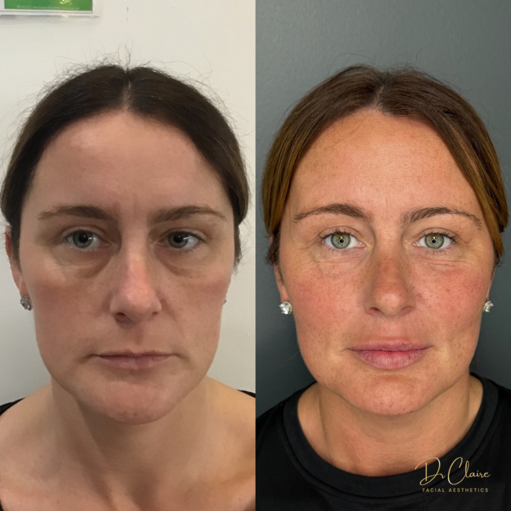 Transformations | Dr Claire Facial Aesthetics | Botox Chorley | Fillers Chorley | Aesthetics Chorley | Botox Treatments Chorley | Dermal Fillers Chorley | Aesthetic Enhancements Chorley