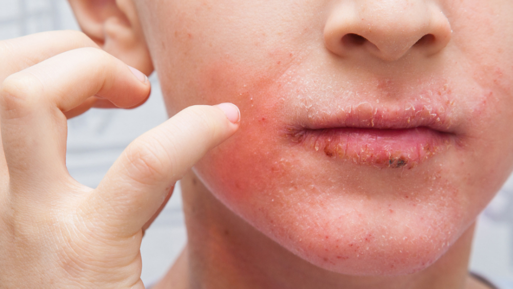 The Multifaceted Nature of Eczema: Unravelling the Underlying Causes