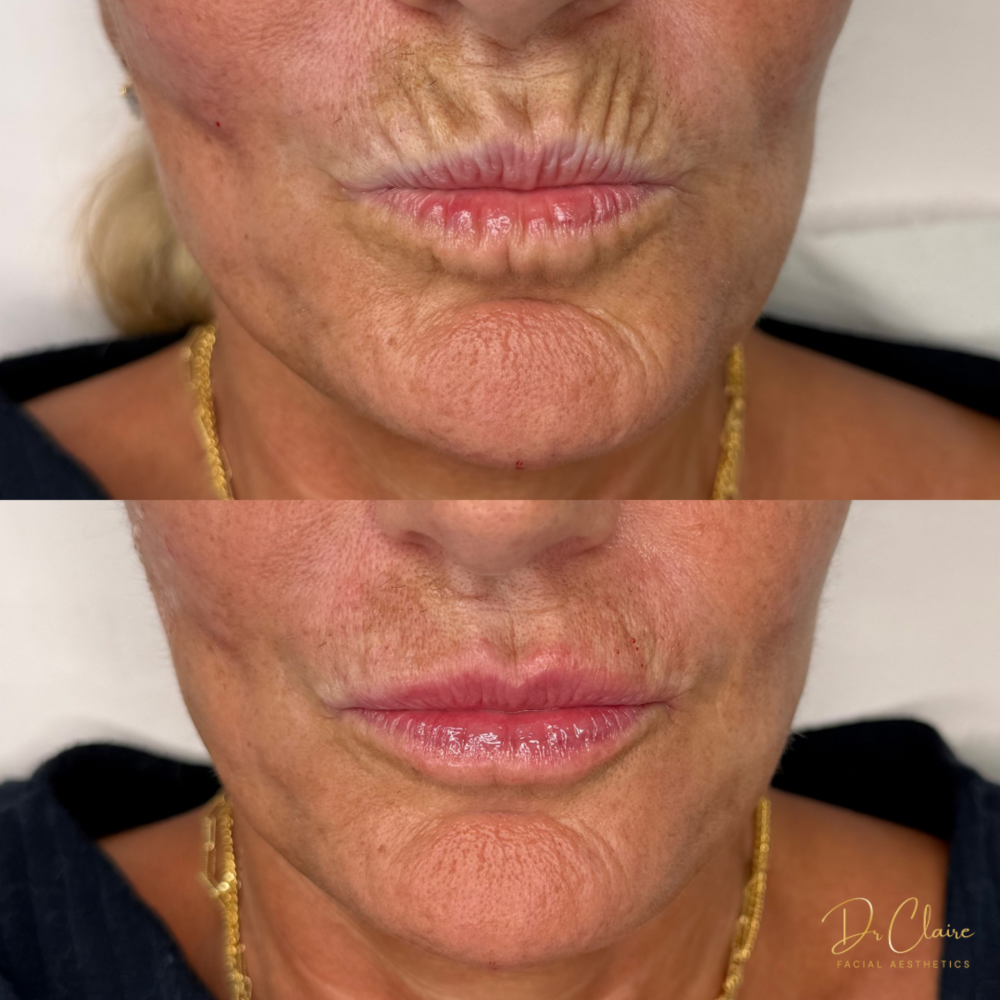 Transformations | Dr Claire Facial Aesthetics | Botox Chorley | Fillers Chorley | Aesthetics Chorley | Botox Treatments Chorley | Dermal Fillers Chorley | Aesthetic Enhancements Chorley