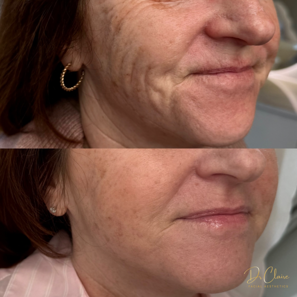 Transformations | Dr Claire Facial Aesthetics | Botox Chorley | Fillers Chorley | Aesthetics Chorley | Botox Treatments Chorley | Dermal Fillers Chorley | Aesthetic Enhancements Chorley