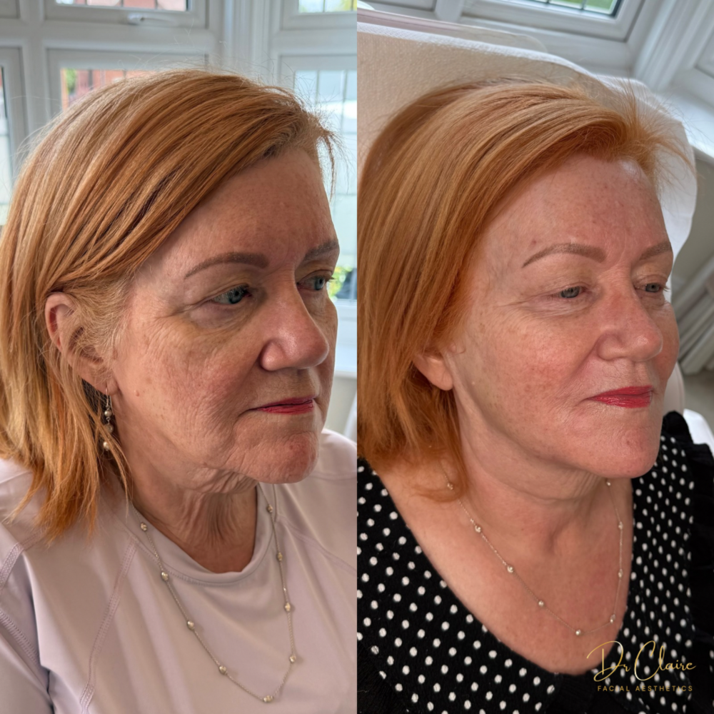 Transformations | Dr Claire Facial Aesthetics | Botox Chorley | Fillers Chorley | Aesthetics Chorley | Botox Treatments Chorley | Dermal Fillers Chorley | Aesthetic Enhancements Chorley