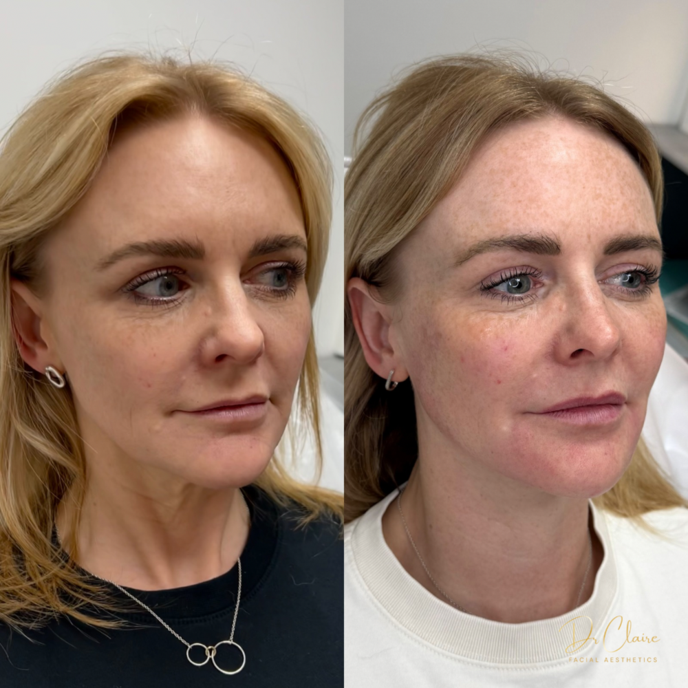 Transformations | Dr Claire Facial Aesthetics | Botox Chorley | Fillers Chorley | Aesthetics Chorley | Botox Treatments Chorley | Dermal Fillers Chorley | Aesthetic Enhancements Chorley