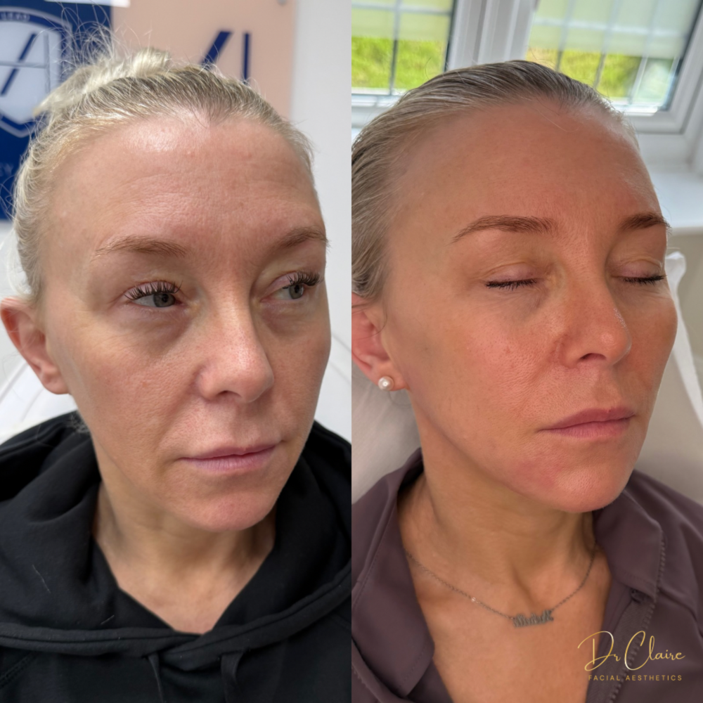 Transformations | Dr Claire Facial Aesthetics | Botox Chorley | Fillers Chorley | Aesthetics Chorley | Botox Treatments Chorley | Dermal Fillers Chorley | Aesthetic Enhancements Chorley