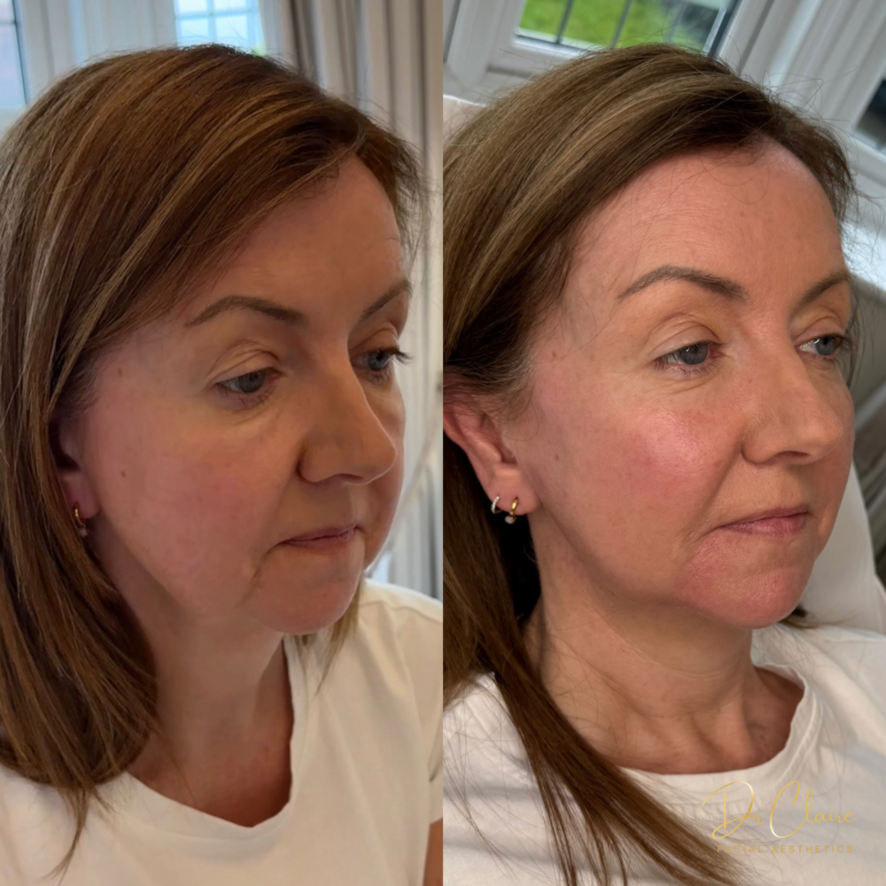 Transformations | Dr Claire Facial Aesthetics | Botox Chorley | Fillers Chorley | Aesthetics Chorley | Botox Treatments Chorley | Dermal Fillers Chorley | Aesthetic Enhancements Chorley