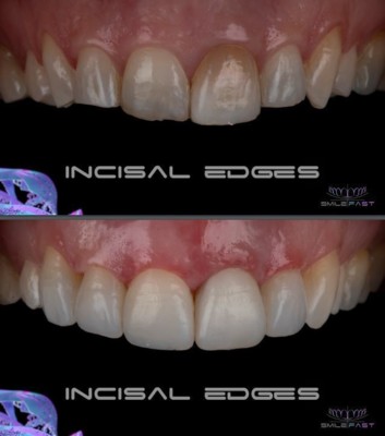 Transformational Smile Makeovers North London