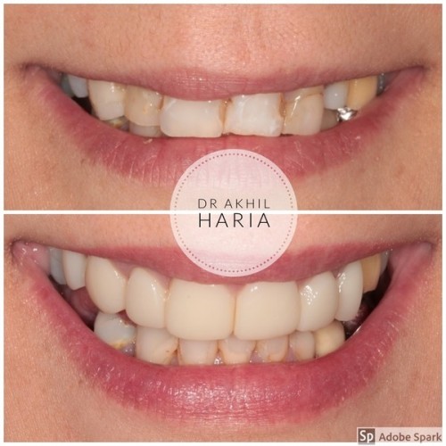 Case Of The Month - Composite Bonding