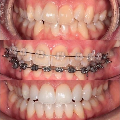 CASE OF THE MONTH - BRACES + WHITENING