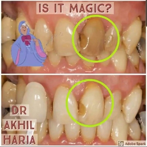 CASE OF THE MONTH - INTERNAL & EXTERNAL WHITENING