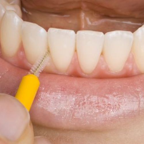 Eyes and Smiles Best Fresh Breath Treatment Clinic for bad breath halitosis condition interdental brushes