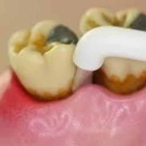 Eyes and Smiles Best Fresh Breath Treatment Clinic for bad breath halitosis condition single tufted brush vertical cleaning