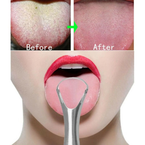 Eyes and Smiles Best Fresh Breath Treatment Clinic for bad breath halitosis condition tongue cleaning