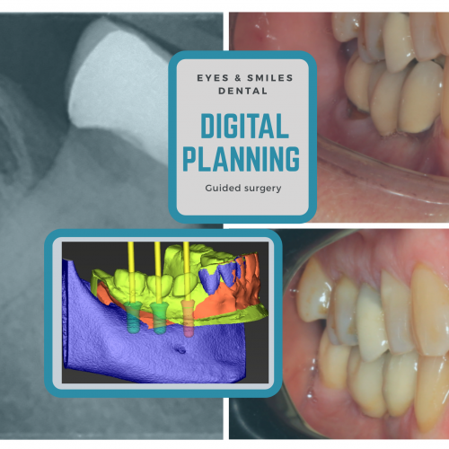 Some of the Important Dental Implant Problems and Its Complications