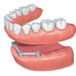 Dental Implants