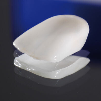 Cosmetic Veneers At Eyes & Smiles Dental Clinic in Bounds Green North London N11, Porcelain veneers, composite veneers, ceramic veneer, dark teeth, hollywood smile, cracked tooth, long lasting, smile makeover, white teeth,