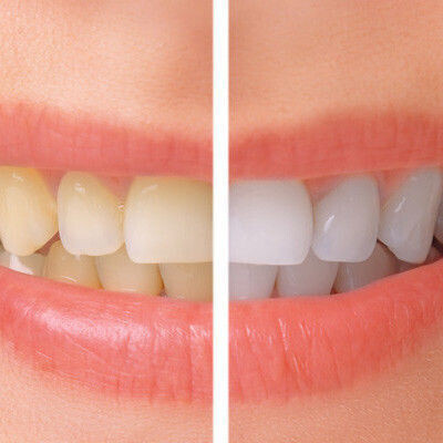 Teeth Whitening & Enlighten Smiles at At Eyes & Smiles Dental Clinic in Finchley, North London N11, Whiter teeth, smoker stains, stain removal, laser whitening, b1 shade teeth, brighter teeth, teeth whitening sensitivity, oral health healer, essex smile, hollywood smile, safe whitening, home whitening, day whitening, night whitening, tray whitening, whitening gel, boutique whitening, white dental beauty, red wine stains, smoking stains, dark tooth, curry stains, white spots