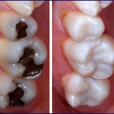 White Fillings & Dental Composite Bonding at Eyes & Smiles Dental Clin Finchley North London N11, Black Triangle Closure, Diastema Gap Closure, Drill free, No drilling, cracked chipped worn teeth treatment, receding gums treatment, tooth sensitivity treatment, mercury free, amalgam free, BPA Free, Direct Composite Veneers, Bioclear,