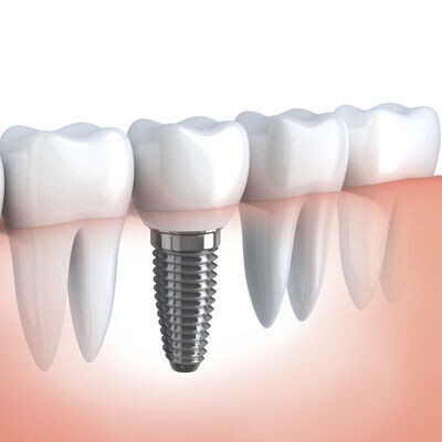 Dental Implants for Missing Teeth Replacements at Eyes & Smiles Dental Clinic Finchley  North London N11 Guided Surgery Straumann All On 4 Same day teeth Bone Graft ITI