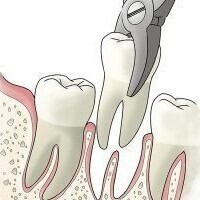 Safe and Well-planned Extractions and Oral Surgery At Eyes & Smiles Dental Clinic in N11 Finchley  North London , oral surgery, extractions, root removal, cyst removal, apicectomy, bone grafting, socket preservation, infection removal, crown lengthening, root sectioning, wisdom tooth removal, hemisection