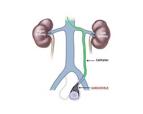 Varicocele Embolization (VE) - Operation Image 4