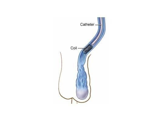 Varicocele Embolization (VE) - Operation Image 5