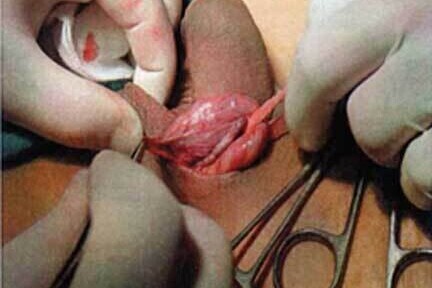 Varicocele Embolization (VE) - Operation Image 7