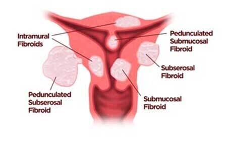 UTERINE FIBROID EMBOLIZATION (UFE) - Image 1