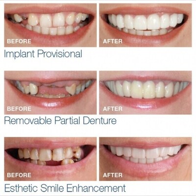 Snap on smiles to replace missing teeth and gaps Instant smile, instant veneers Friern Barnet