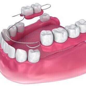 Replace missing teeth with dentures quickly and easily in Southgate