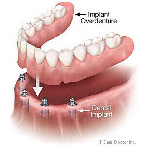 Permanent Screw In Dentures to give you the best fitting dentures in Finchley