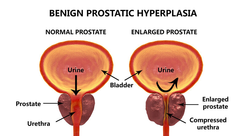 Prostate Artery Embolization (PAE)