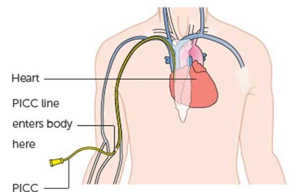 Vascular Access/Lines - Image 1