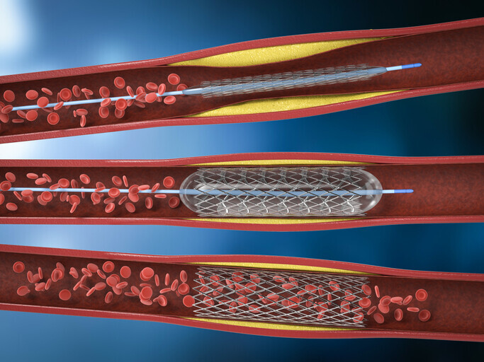 Arterial Disease - Image 1