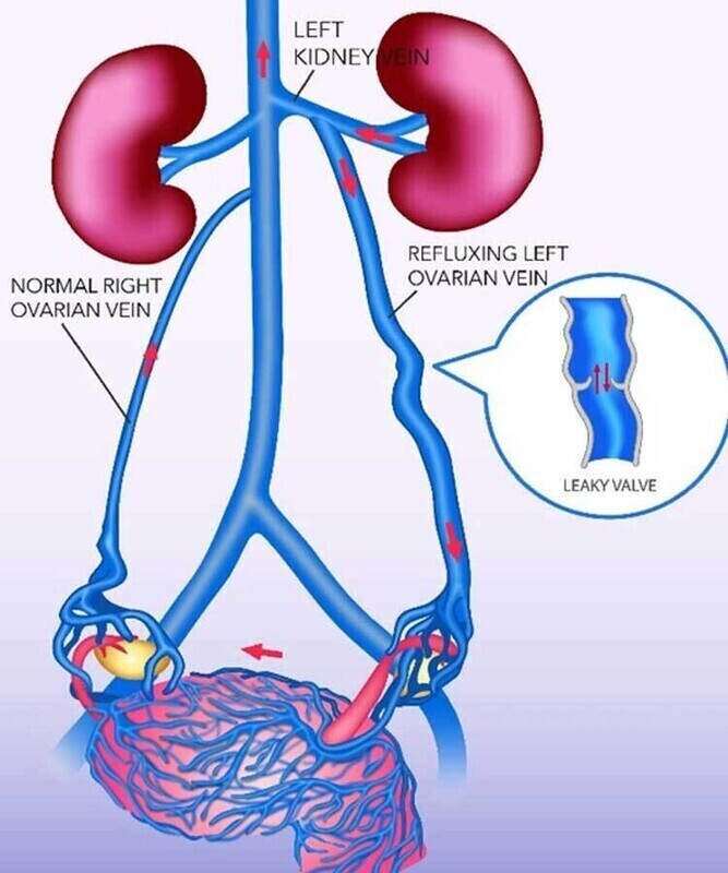 Pelvic Congestion Syndrome - Image 1