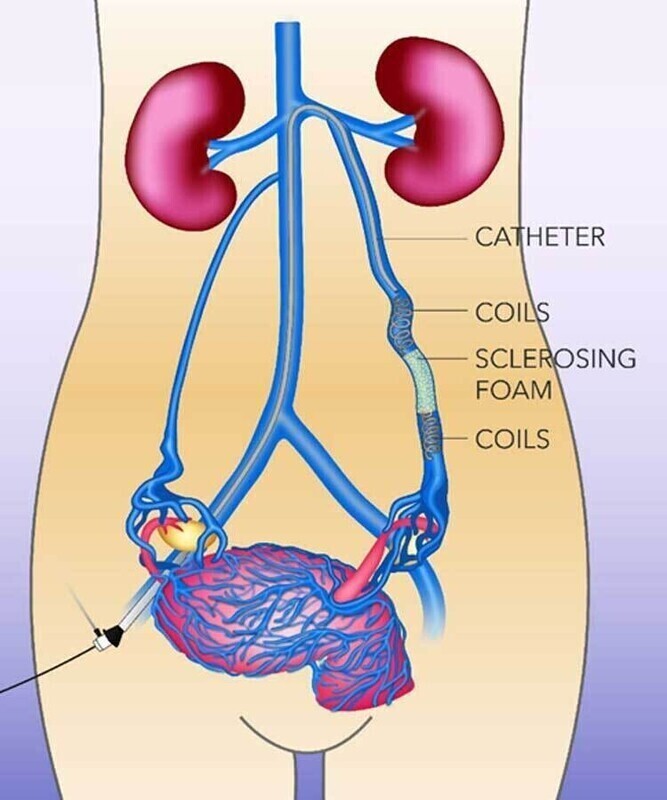 Pelvic Congestion Syndrome - Image 2