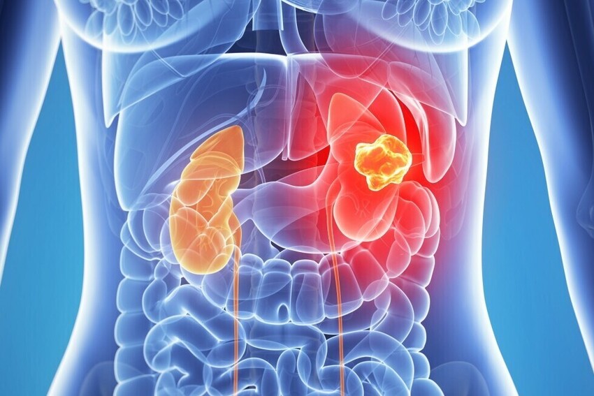 Percutaneous Kidney Tumour Ablation - Image 1
